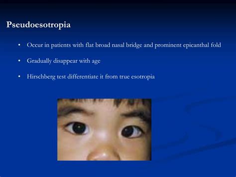 My 19 m.o has epicanthal folds and flat nasal bridge but no other physical signs of ds. PPT - Strabismus, Amblyopia & Leukocoria PowerPoint ...