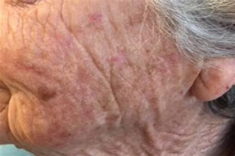 Actinic Keratosis The Common Precancer You Should Know About Center Images