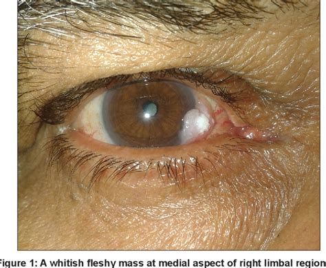 Figure 1 From Limbal Complex Choristoma A Rare Unexpected Lesion