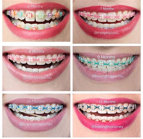 Pin By Shaniya Alexis On Brace Face Teeth Braces Braces Colors