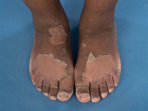 Dyshidrosis On Foot Pictures Photos