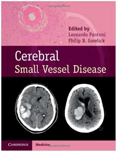 Frontiers Book Review “cerebral Small Vessel Disease” Whats The
