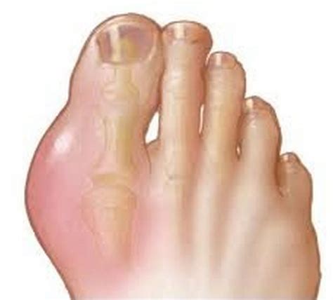 Healthool Sprained Toe Symptoms Vs Broken Big Toe