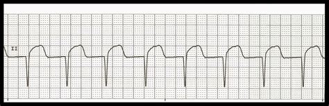 Float Nurse: Practice EKG Strips 416