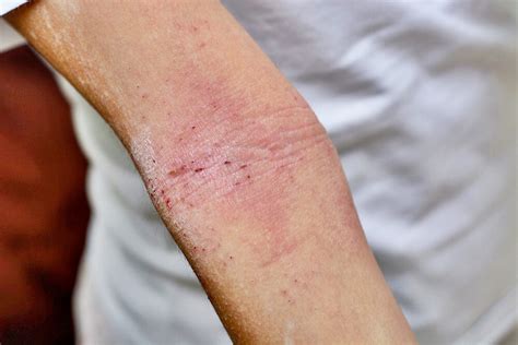Skin Rash Causes In Adults