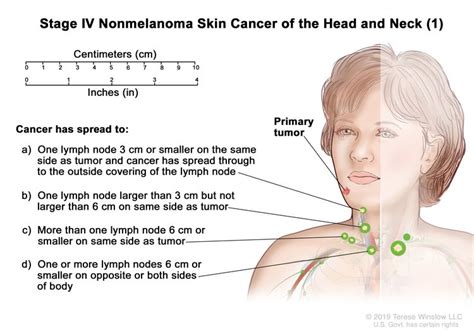 Stage Iv Nonmelanoma Skin Cancer Of The Head And Neck 1 Drawing
