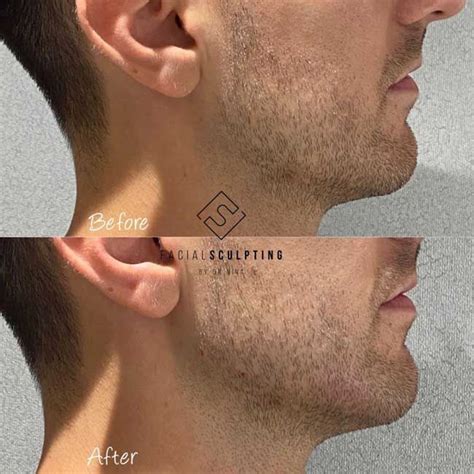 Jawline Sculpting Before And After The Best Treatments For A Defined