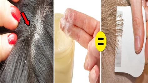 How To Get Rid Of Nits And Head Lice Naturally Permanently Youtube
