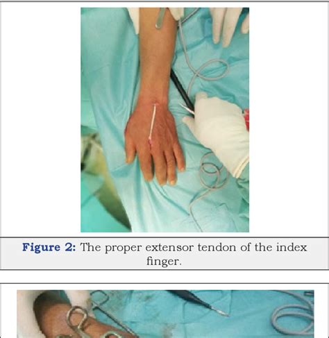 Pdf Subcutaneous Rupture Of The Long Extensor Tendon Of The Thumb