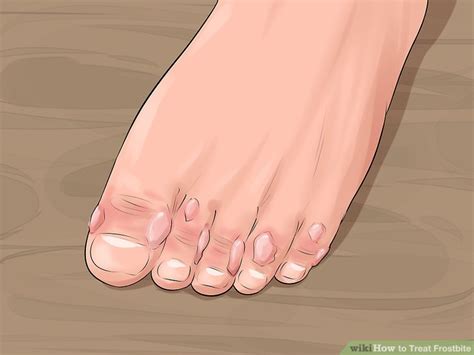 How To Treat Frostbite 13 Steps With Pictures Wikihow