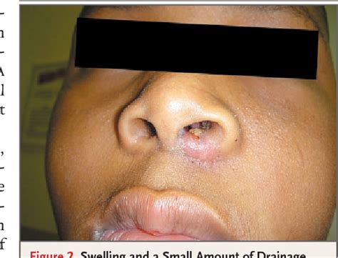 Staphylococcus Aureus Infection In Nose