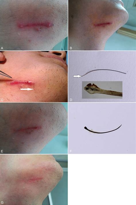 Does An Ingrown Hair Cause A Swollen Lymph Node Lipstutorial Org