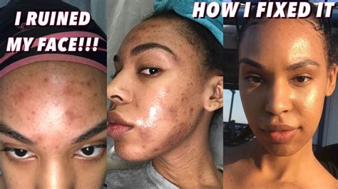 How I Ruined My Skin Chemical Burn Hyperpignmentation Face Peel