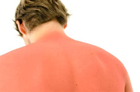 Sunburn Stock Photos Pictures And Royalty Free Images Istock