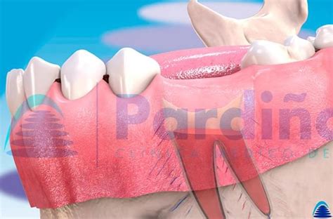 Alveolitis Dental Infección Tras Extracción Causa Y Tratamiento Clínica Pardiñas