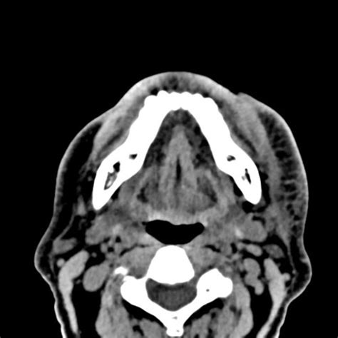 Prueba Skull Head And Neck Cts