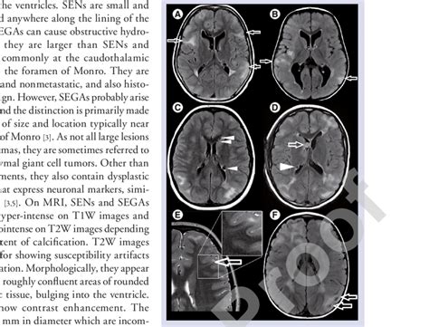 Conventional Mri Findings In Tuberous Sclerosis Complex A And B Axial