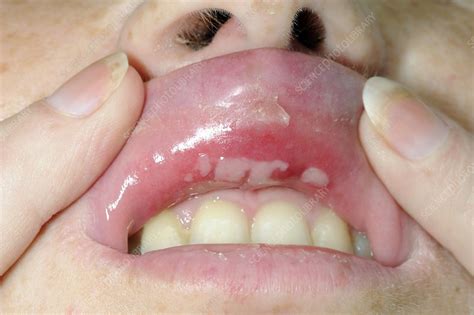 Aphthous Ulcers Inside Upper Lip Stock Image C Science