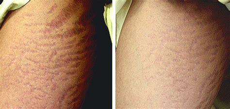 Stretch Mark Removal Before And After Photos Treatment Reduction