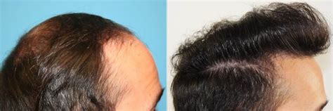 Year Old Caucasian Male Brown Fut Hair Transplant Before After