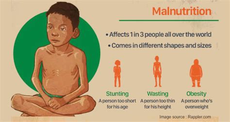 Malnutrition Problem And Need For Holistic Solution Severe Acute