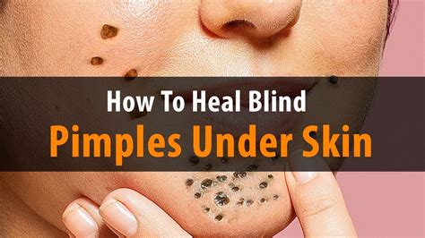 What To Do For A Blind Pimple Blinds