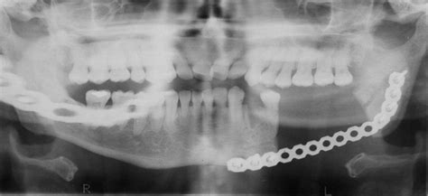 Bisphosphonate Related Osteonecrosis Of The Jaw In Patients With