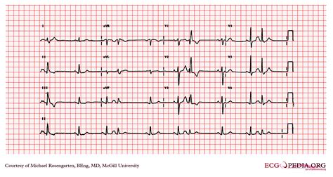 Premature Atrial Contraction Electrocardiogram Wikidoc
