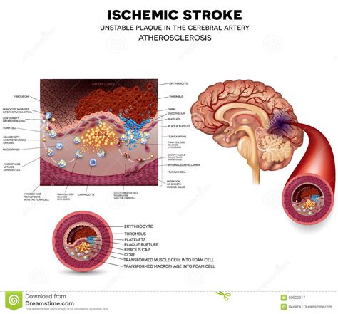 Hemorrhagic strokes account for about 20% of all strokes, and are divided into categories depending on the site and cause of the bleeding: Stroke and thrombus stock illustration. Illustration of ...