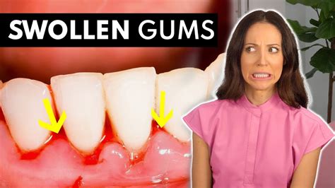What SWOLLEN GUMS Are Telling You What To Do About It YouTube