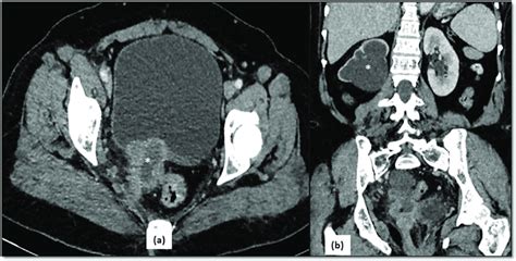 Ct In Stage Iva Of Carcinoma Cervix A Axial Ct Image Shows An