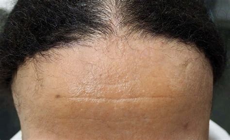 ¿qué Es La Alopecia Frontal Fibrosante Características Destacadas