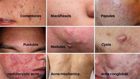 How To Prevent Acne Through Basic Lifestyle Changes Gilgeth A