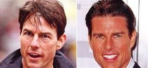 Tom Cruise Plastic Surgery Teeth Nose Job Hair Facelift