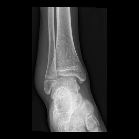 Teenager With Lateral Malleolus Pain After A Motor Vehicle Accident