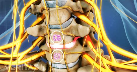All About The C6 C7 Spinal Segment In The Neck