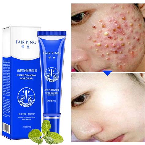 Cystic Acne Spot Cream Fast Acting Formula Cream For Clearing Severe Acne From Face Body