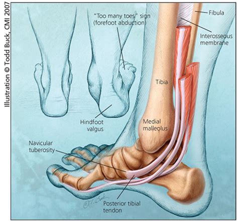 Tendon, tissue that attaches a muscle to other body parts, usually bones. Adult Acquired Flatfoot: An Overview | HSS Foot & Ankle