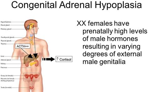 Identifying Symptoms Of Congenital Adrenal Hyperplasia My Xxx Hot Girl