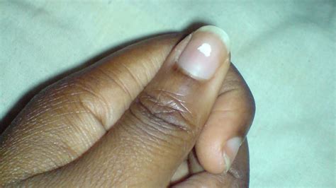 10 Zinc Deficiency And Fingernails Trends Fashion Daily