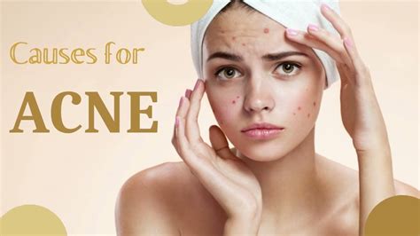 Causes For Acne Best Dermatology Centres In Jayanagar Bangalore