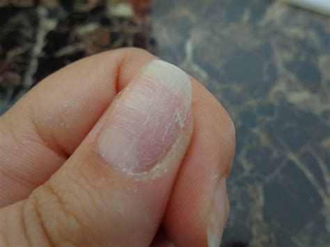 7 Easy Steps To Fix A Cracked Nail At Home Tshanina Peterson