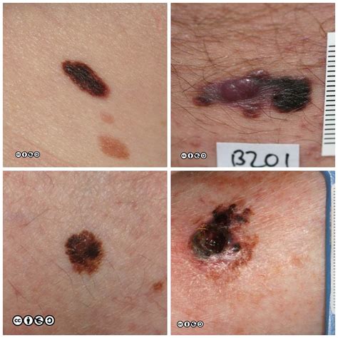 Fico 15 Elenchi Di Melanoma Malignant Skin Cancer Images This Is