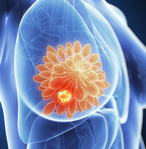 Astrazeneca’s Truqap Plus Faslodex Approved By Fda For Treatment Of Breast Cancer