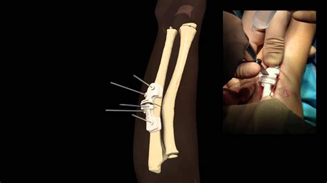 Correction Of Forearm Malunion With Patient Specific 3d Printed Guides