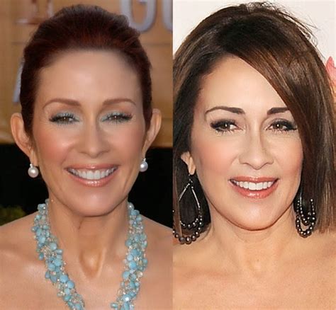 Patricia Heaton Before And After Plastic Surgery