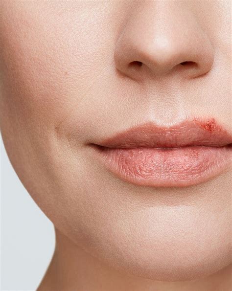 Herpes On Lips Early Stages