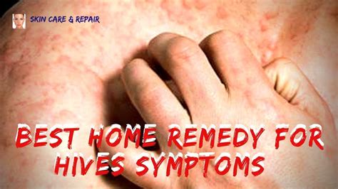 Pin By Herbals Daily On Oxyhives Review Home Remedies For Hives