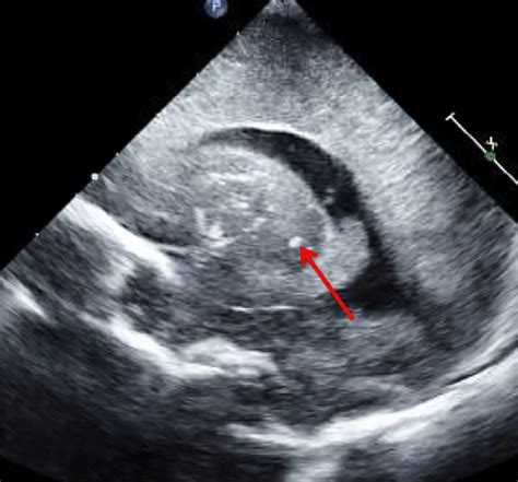 Sagittal View Of The Neonatal Cranial Ultrasound Showing Ventricular