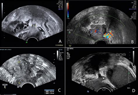 uterosacral ligament ultrasound sexiz pix